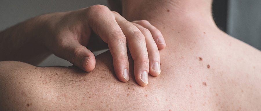 Patient befühlt Muttermale im Zuge der eigenen Hautkrebsvorsorge